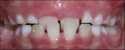 Crossbites