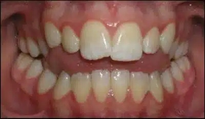 Open Bites