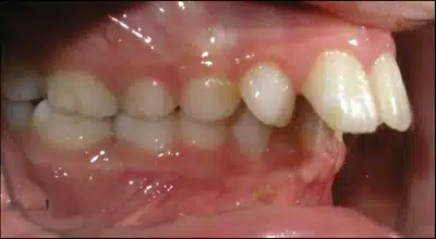 Overbites