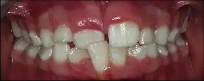 Crossbites