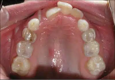 Can Invisalign fix crowding
