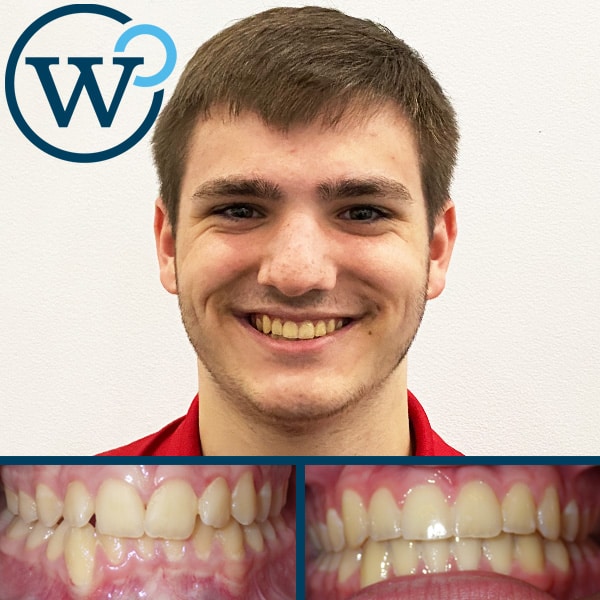 Success Stories Archive Page 3 of 5 b Orthodontics