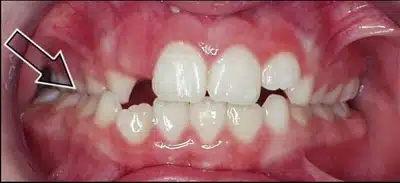 Crossbites