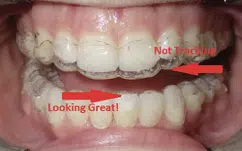 Invisalign Illustration