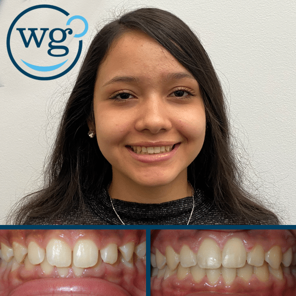 Fast Invisalign Teen South Charlotte Nc