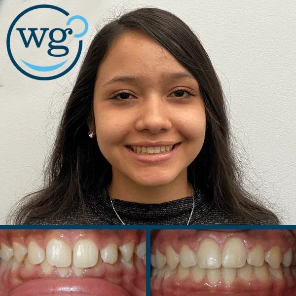Fast Invisalign Teen South Charlotte Nc