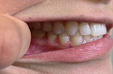 Invisalign Online Consultation Charlotte Nc Right 1