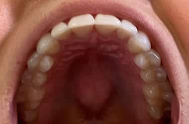 Virtual Consultation Invisalign Charlotte Nc