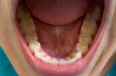 Virtual Invisalign Consultation Charlotte Nc Bottom