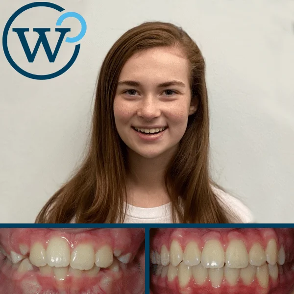 Crowding and Overbite with Braces in 20 Months