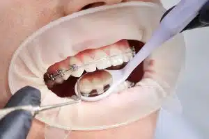 Open Bite Treatment