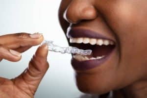Open Bite Treatment Options: What You Need To Know 3 Open Bite Treatment