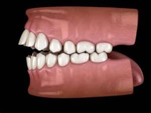 Open Bite Treatment Options: What You Need To Know 2 Open Bite