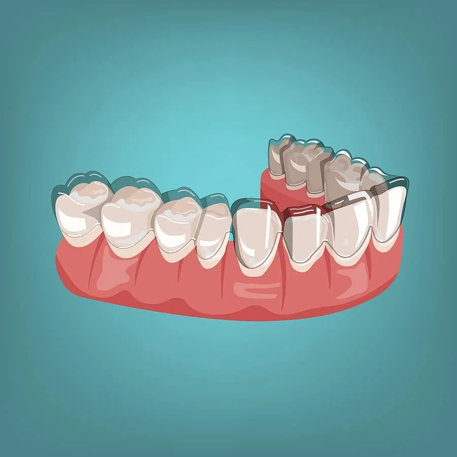 Can Invisalign Fix Crowding?