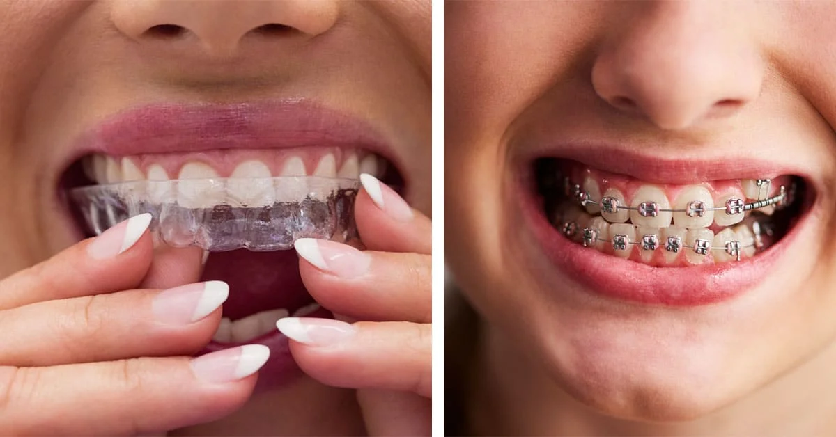 Invisalign Vs Braces