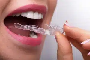How Old Do I Need To Be To Get Invisalign?