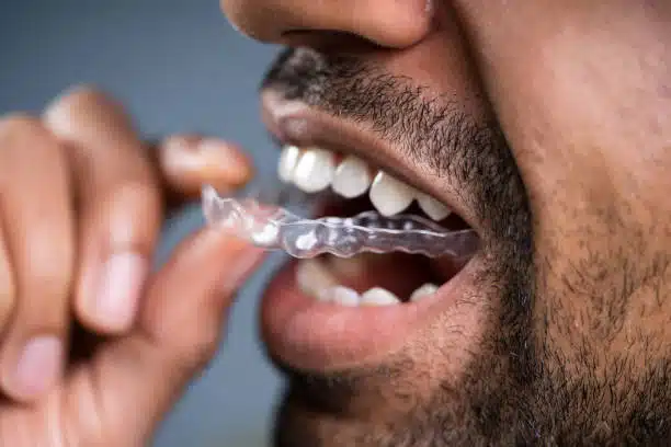 Invisalign: Transforming Smiles, Unveiling The Journey'S Timeline 2 How Long Does Invisalign Take To Work?