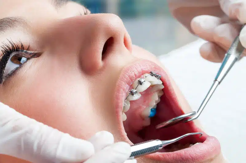 Understanding Braces Treatment Duration