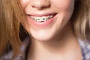 Different Types Of Dental Braces