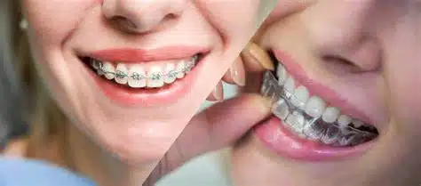 Invisalign Vs Braces