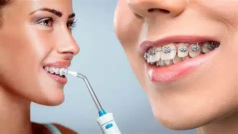 Taking Care Of Your Braces