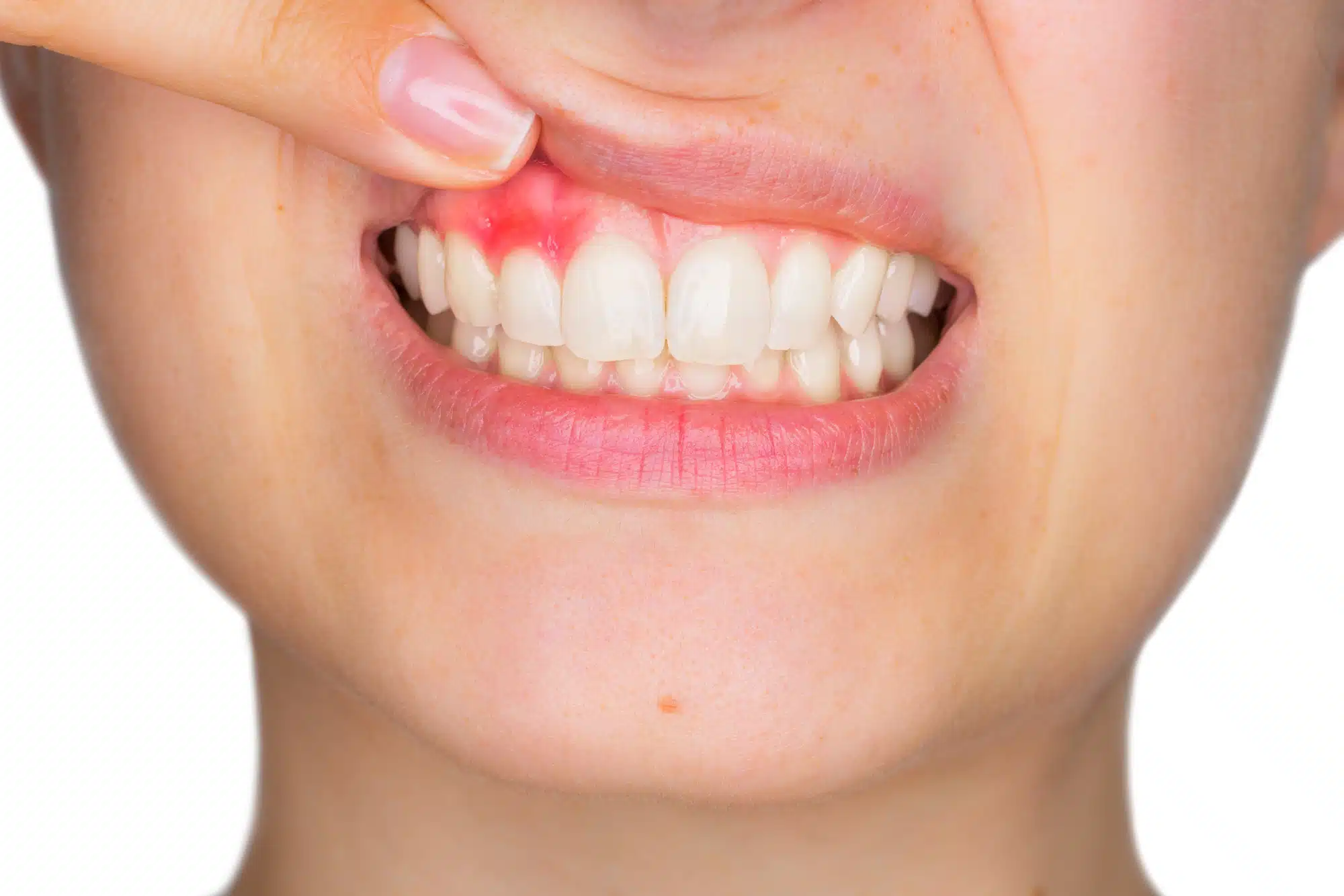 Bleeding Gums Treatment: What Should Patients Know? 7 Bleeding Gums Orthodontics