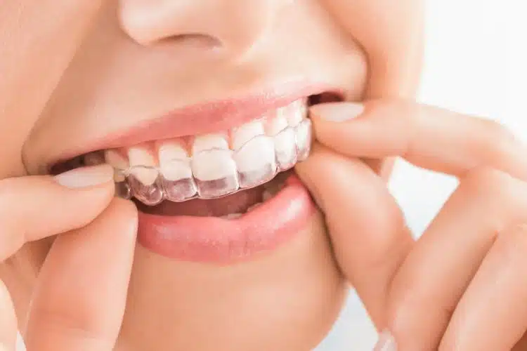 Invisalign In Ballantyne, Nc | Get A Confident Smile 3 Patient Wearing Clear Aligners During Ballantyne Nc Invisalign Treatment