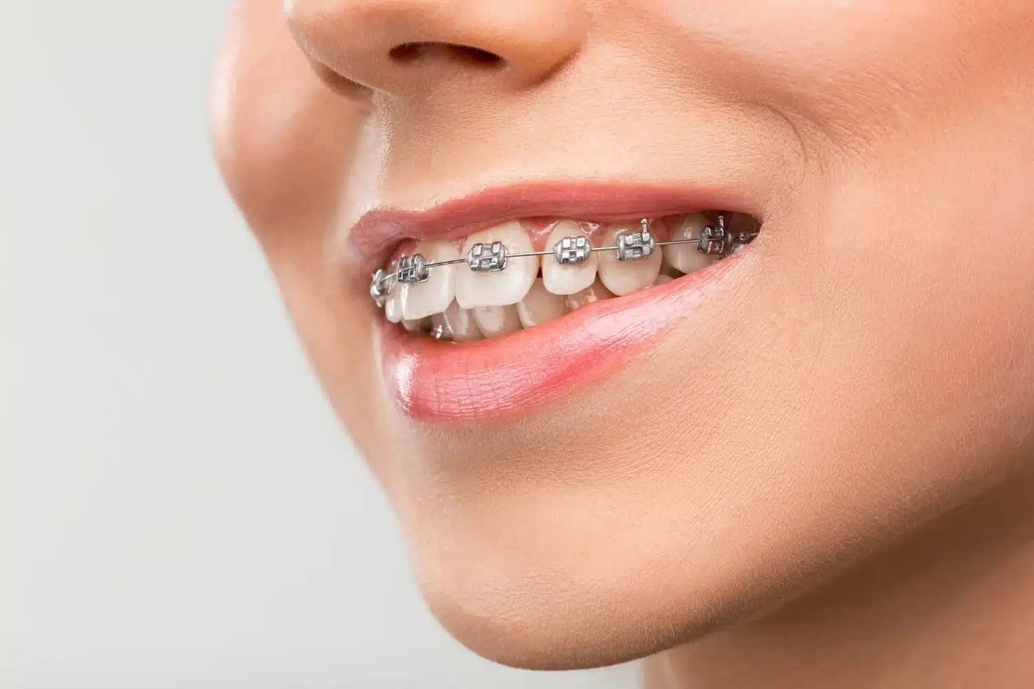 Women With Ballantyne Braces