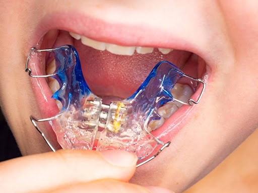 Kinds Of Palatal Expanders