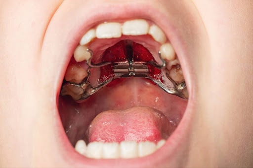 How Many Types Of Palatal Expanders Are There