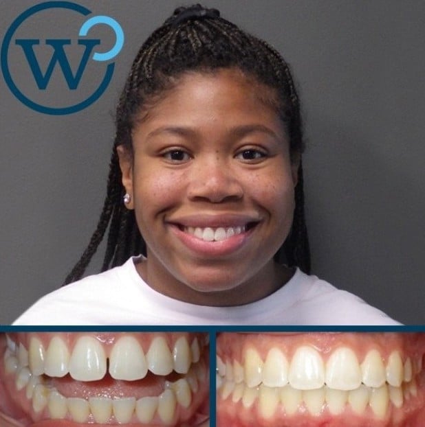 Braces Before And After Result Near Matthews Nc