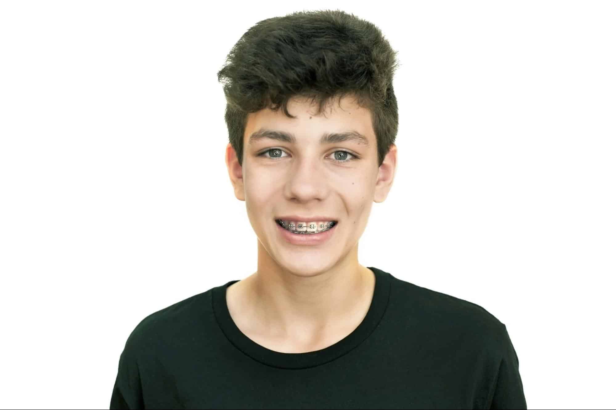 Braces Near Matthews Nc Teen Smile