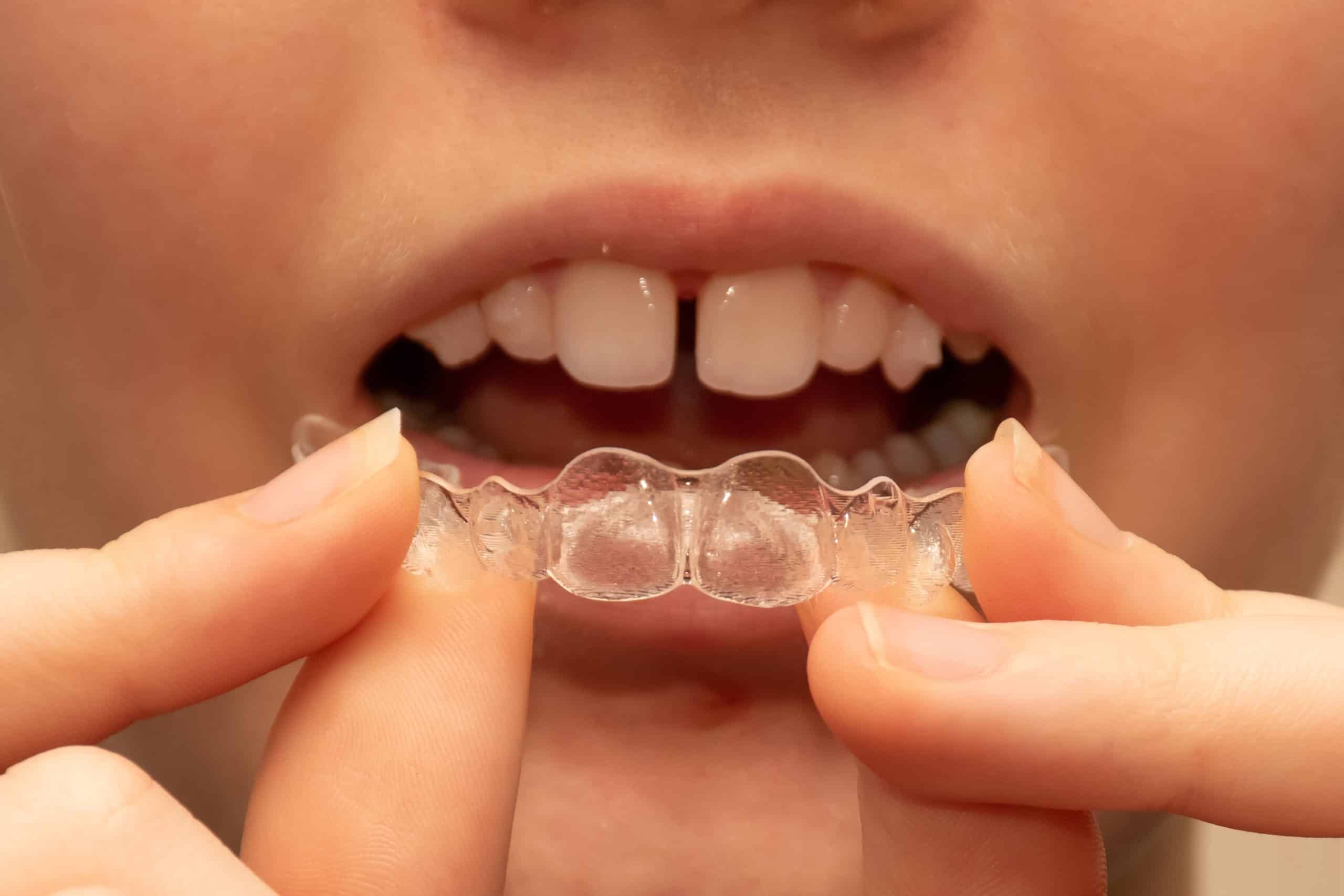 Teen Smiling During Invisalign Treatment Near Matthews Nc